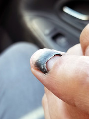 Thumb with detached nail and old hematoma , selective focus draws eye to injury