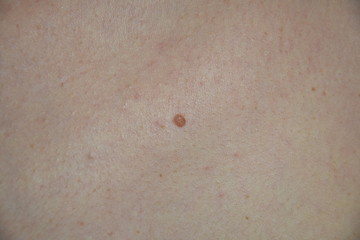 Woman skin with acne and moles problem
