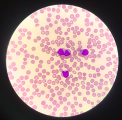 Immature cell or bast cell in leukemia patiens.