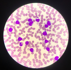 Immature cell or bast cell in leukemia patiens.