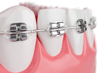 Close up Beauty Health Teeth with Brace. Selective focus. 3D Render.
