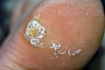 Mosaic wart on the heel of a foot 2.