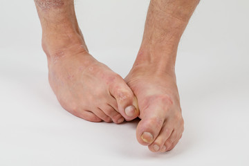Close-up of the legs of a man suffering from chronic psoriasis on a white background.