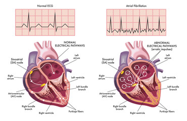 Medical illustration showing the symptoms of a heart with atrial fibrillation compared to normal one. - obrazy, fototapety, plakaty