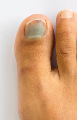 Naklejka premium subungual hematoma blue and black toe nail