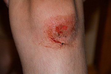 Fresh bleeding abrasion on the knee