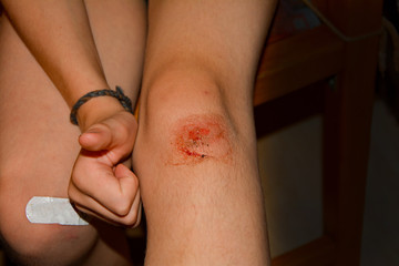Fresh  wound, child holds knees with hands with thumbs up