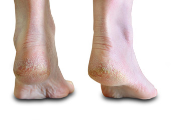 skin dry on the heels skin disease cracks white background
