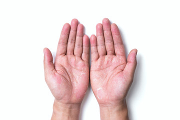 Dry hands, peel, Dermatitis.Allergic to chemicals.Eczema