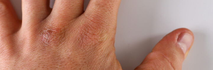 Damaged male arm with corrupted dry skin closeup on white background