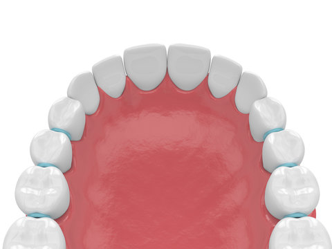 3d render of rubber separators between teeth