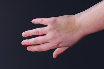 Female hand with big bruise on white background. Ointment treatment. Domestic violence or not...