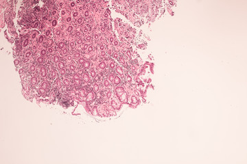 View in microscopic of ductal cell carcinoma, adenonocarcinoma from human breast cancer, tissue...