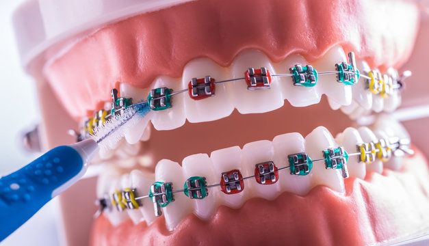 Tooth model from dental braces with inter dental teeth cleaning brush