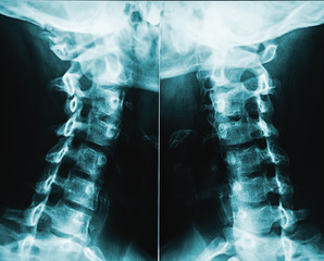 X-ray image or radiography of human male neck vertebrae or cervical rachis.