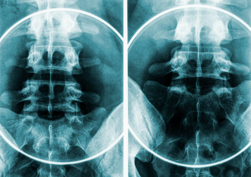 X-ray imagery or radiography of human male pelvis and lumbar vertebrae.
