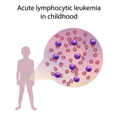 Acute lymphocytic leukemia in childhood. Immature lymphocytes. Medical anatomy illustration.