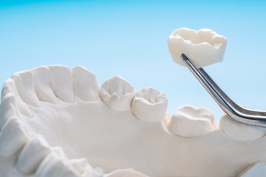 Closeup / Prosthodontics or Prosthetic / Single teeth crown and bridge equipment model express fix restoration.