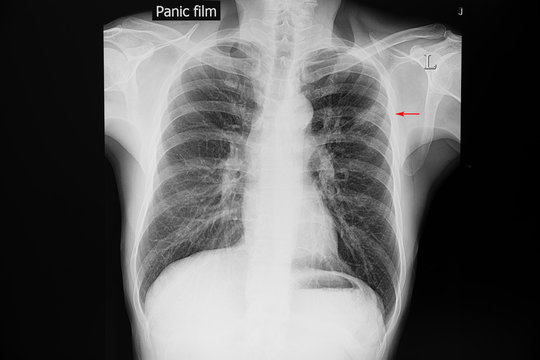 Chest Xray film of a patient with tuberculosis