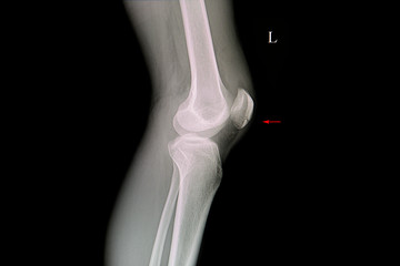 x ray film of a patient with fractured patella