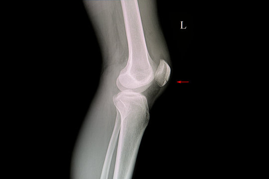 x ray film of a patient with fractured patella