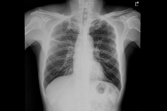 Chest xray film of a patient with pneumonia
