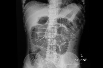 x-ray film of a patient with bowel obstruction.