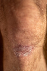 Skin disease - psoriasis on the knee