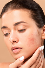 young woman touching face with problem skin isolated on beige