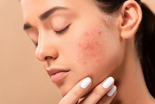 young woman with closed eyes touching face with acne isolated on beige