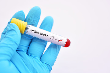 Obraz premium Blood sample tube positive with Wuhan virus, novel coronavirus 2019 found in Wuhan, China