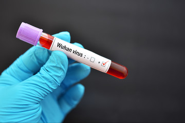 Fototapeta premium Blood sample tube positive with Wuhan virus, novel coronavirus 2019 found in Wuhan, China
