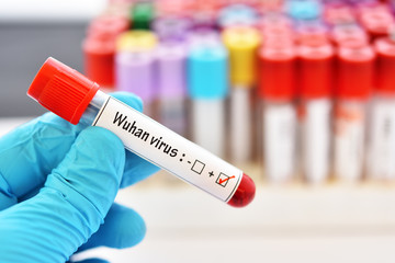 Obraz premium Blood sample tube positive with Wuhan virus, novel coronavirus 2019 found in Wuhan, China