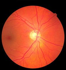 View inside human eye disorders showing retina, optic nerve and macula. Retinal picture ,Medical photo tractional eye screen retinal detachment of diabetes. Eye treatment concept.