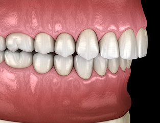 Overbite dental occlusion ( Malocclusion of teeth ). Medically accurate tooth 3D illustration - obrazy, fototapety, plakaty