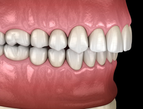 Overbite dental occlusion ( Malocclusion of teeth ). Medically accurate tooth 3D illustration