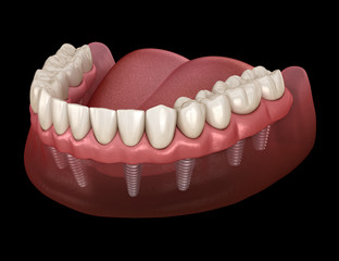 Obraz premium Mandibular prosthesis All on 8 system supported by implants. Medically accurate 3D illustration of human teeth and dentures concept