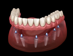 Mandibular prosthesis All on 8 system supported by implants. Medically accurate 3D illustration of human teeth and dentures concept