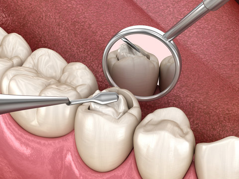 Decayed tooth restoration with composite filling. Medically accurate tooth 3D illustration.