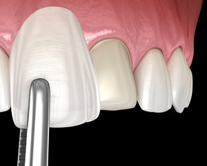Dental Veneer installation procedure over central incisor. 3D illustration