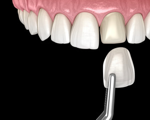 Dental Veneer installation procedure over central incisor. 3D illustration