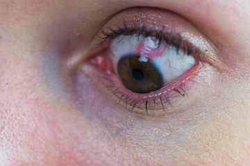 Eye with bloody sclera from laser eye surgery damage. Blood cells in eye, visiblely bloodshot....