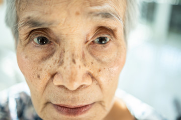 Exhausted asian senior woman suffering from insomnia,.chronic insomnia or allergies causing her sunken eye, dark circles, blear eyed,female elderly feeling tired,fatigued, not get a wink of sleep