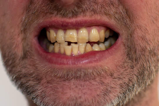 Bad bite in a man, yellow crooked teeth in a man, dental care