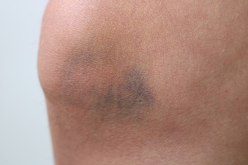 bruises on the woman's knee on white background close up