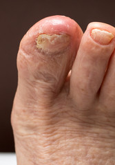 Big toe infected with fungus and an ingrown nail