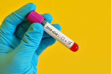Blood sample tube positive with coronavirus 2019 or 2019-nCoV, novel coronavirus found in Wuhan,...