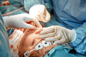 A surgeon with gloves is operating on his nose. Rhinoplasty, close-up operation. Blue light,...