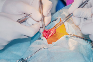 Laparotomy. The process of peritoneal incision (concept of emergency surgery).