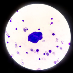 Abnormal cells in pleural fluid.